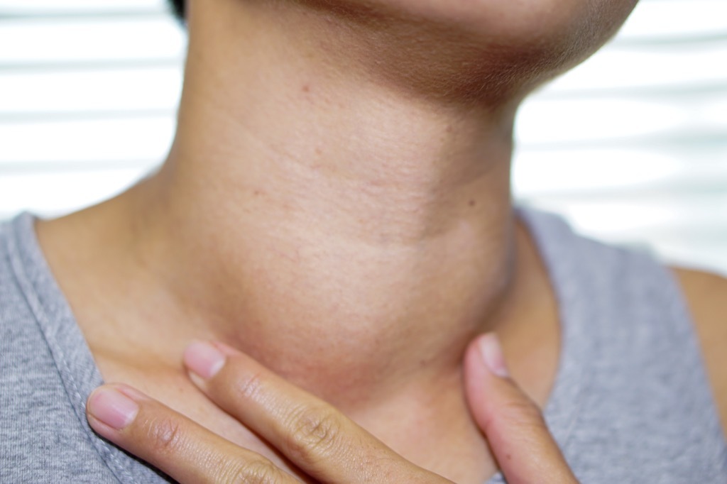 Goiter {Thyroid Problems}