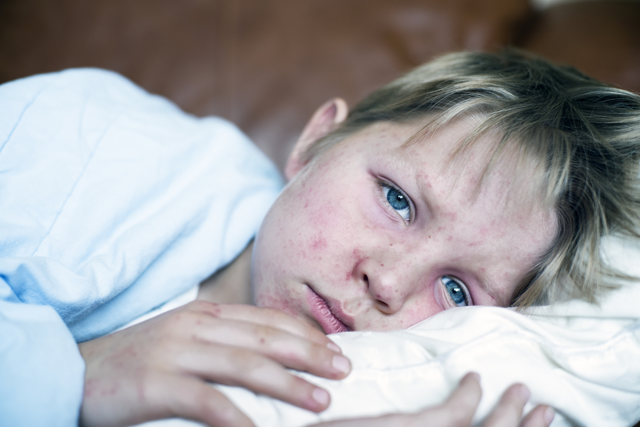 A young boy sick in bed with measles