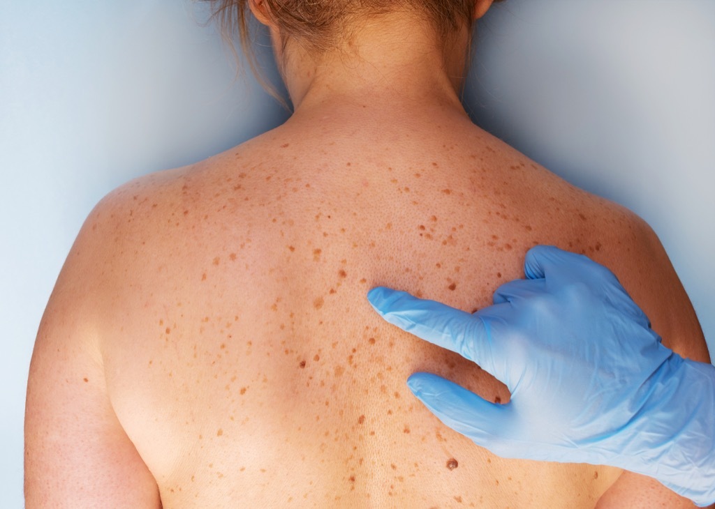 new moles, skin cancer facts