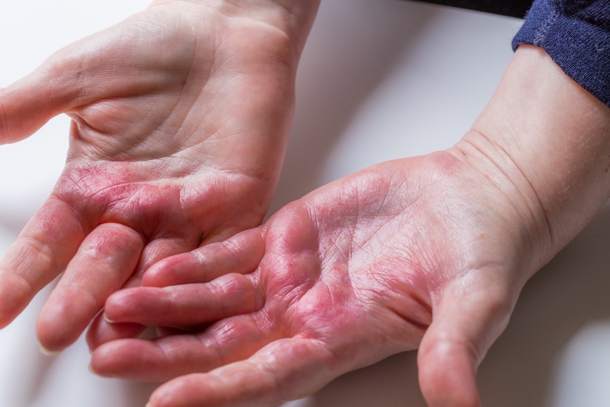 Atopic dermatitis, Red, itchy hands with blisters and chapped skin.