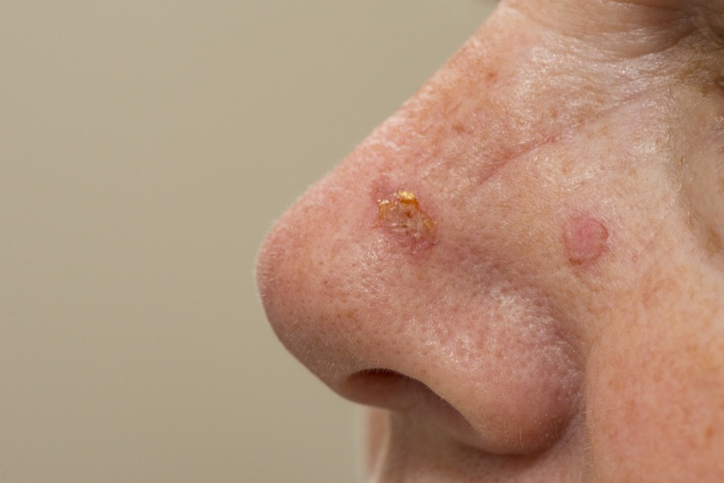 Woman with Actinic Keratosis Sun