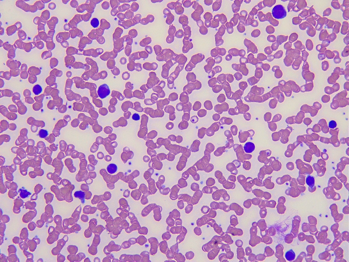 Microscopic image of a blood slide. Mononucleosis. Lymphocytes and monocytes are stained violet, red blood cells are red.