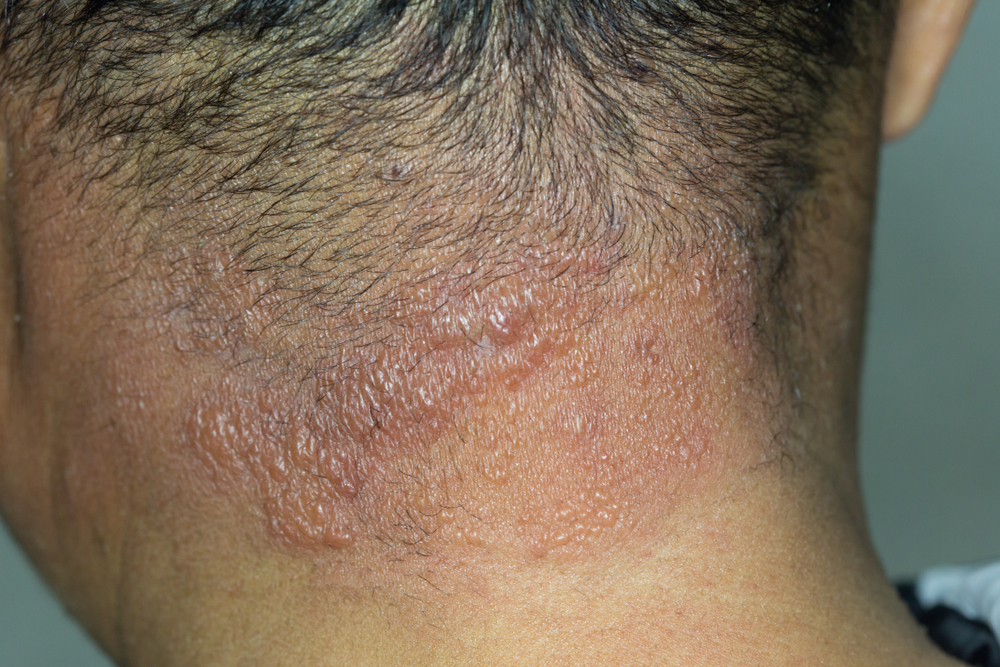 blistering vesicular rash on neck