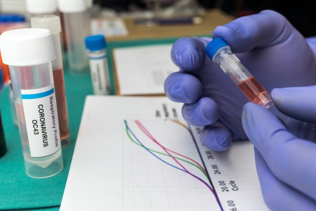 Scientist studies the curves of the Covic-19 pandemic and the dna of an infected person, holding a sample vial in a hospital