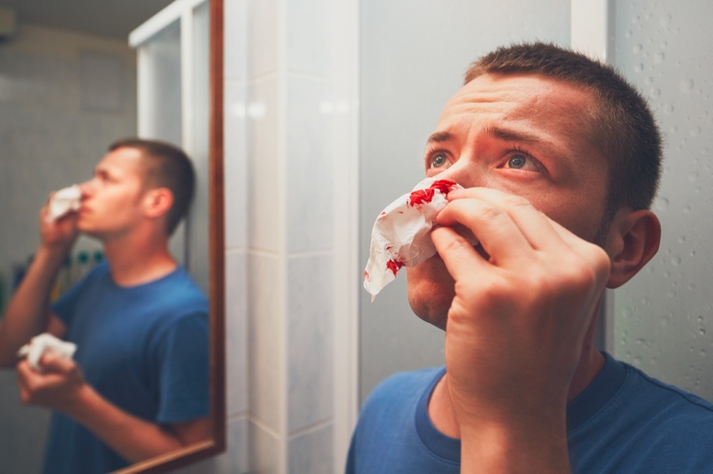 Man having a nosebleed nose bleed